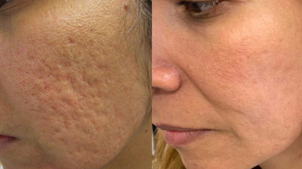 Acne Scars